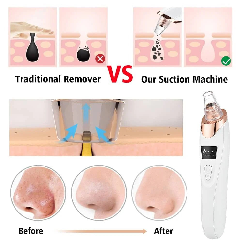 Professional Electric Blackhead Remover – 5-in-1 Vacuum Acne & Pore Cleaner